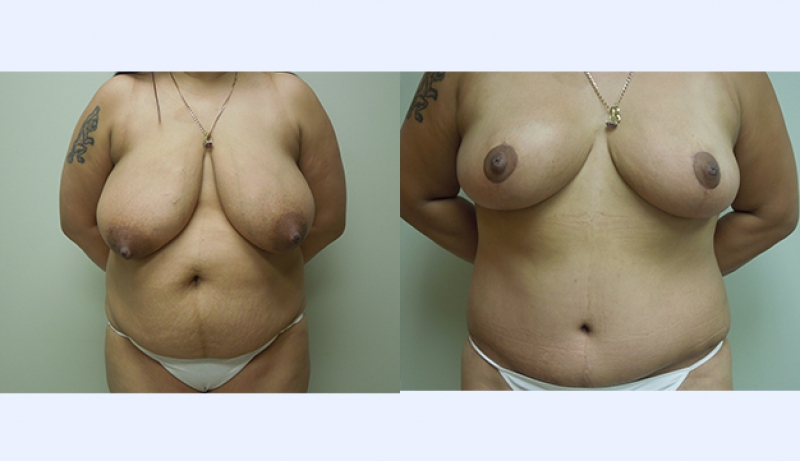 Breast Reduction Before & After Photos | Rottman Plastic Surgery