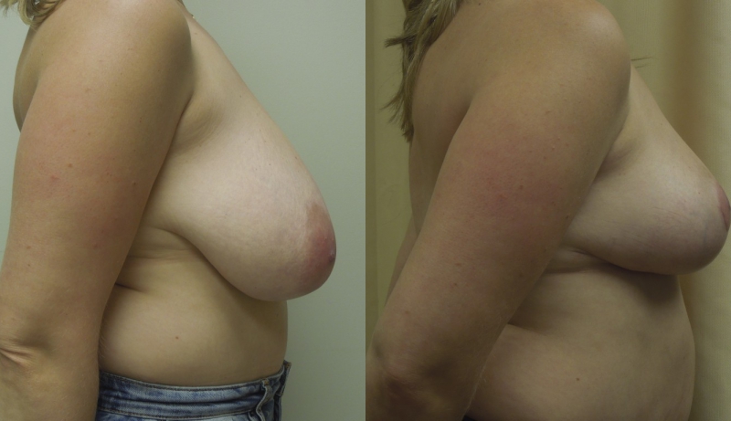Breast Reduction Before & After Photos | Rottman Plastic Surgery