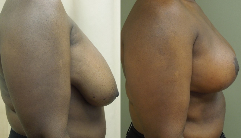 Breast Reduction Before & After Photos | Rottman Plastic Surgery
