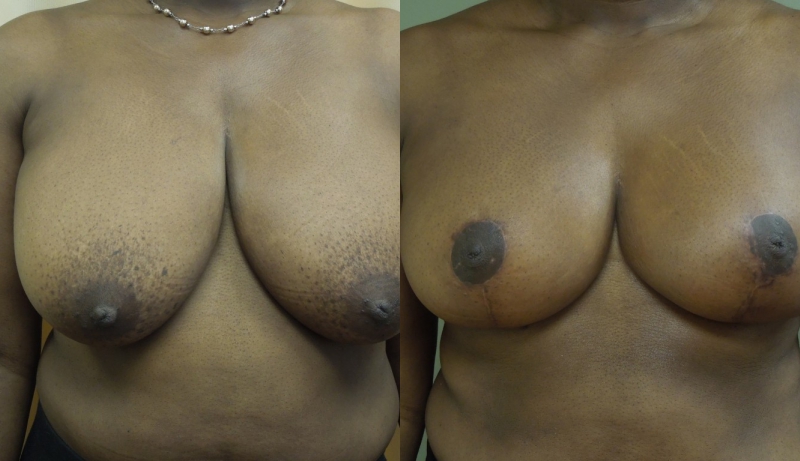 Breast Reduction Before & After Photos | Rottman Plastic Surgery