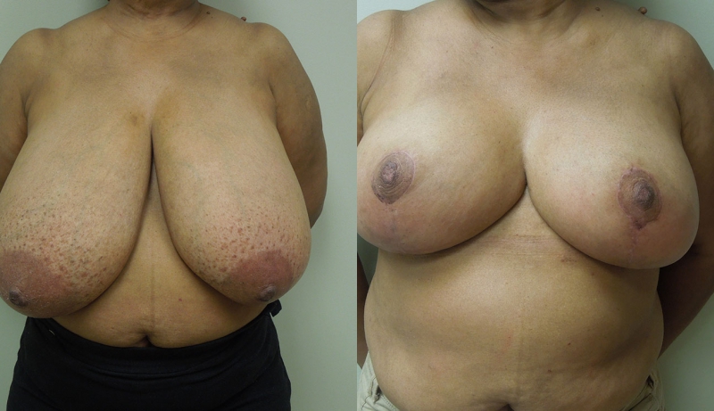Breast Reduction Before & After Photos | Rottman Plastic Surgery