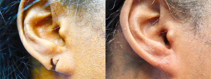 Ear Surgery Before & After Photos | Rottman Plastic Surgery