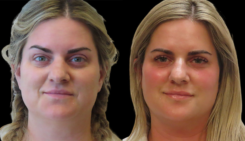Facial Sculpting Before & After Photos | Rottman Plastic Surgery