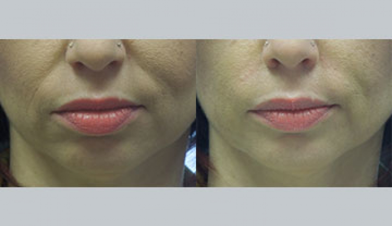 Facial Sculpting Before & After Photos | Rottman Plastic Surgery