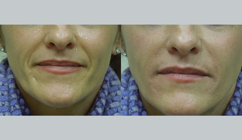 Facial Sculpting Before & After Photos | Rottman Plastic Surgery