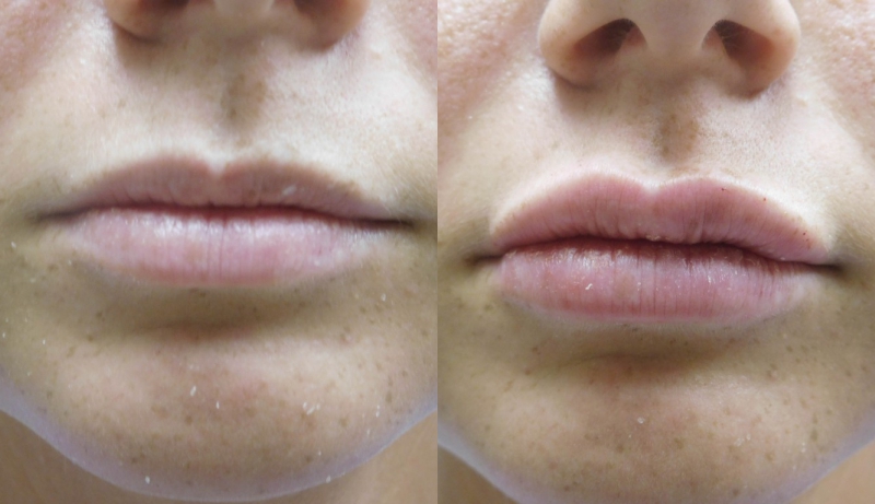 Facial Sculpting Before & After Photos | Rottman Plastic Surgery