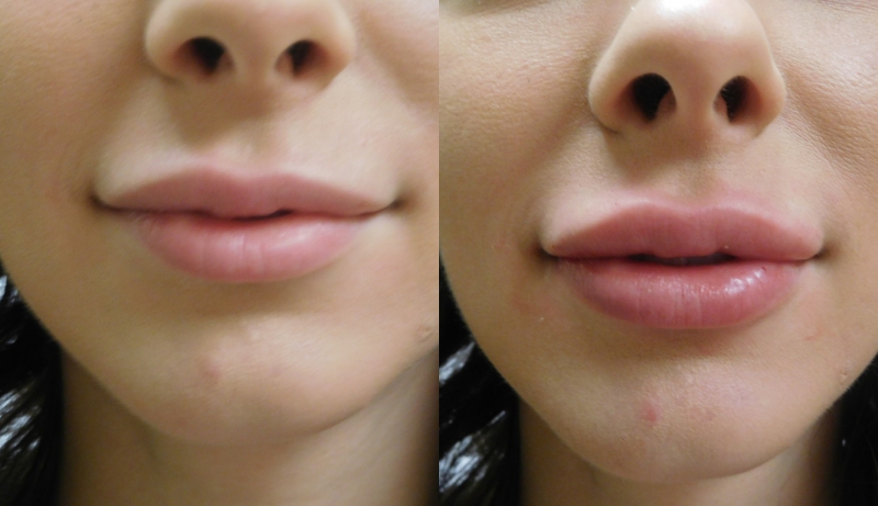 Facial Sculpting Before & After Photos | Rottman Plastic Surgery