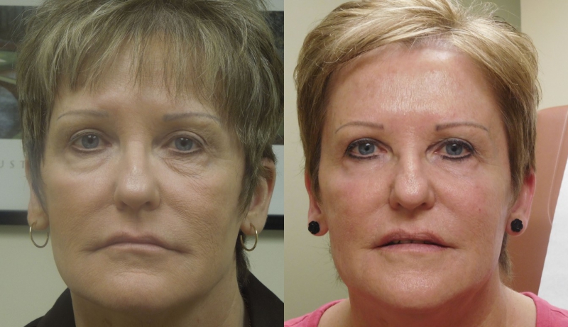 Injectables And Dermal Fillers Before & After Photos | Rottman Plastic Surgery
