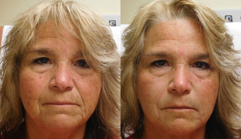 Injectables And Dermal Fillers Before & After Photos | Rottman Plastic Surgery