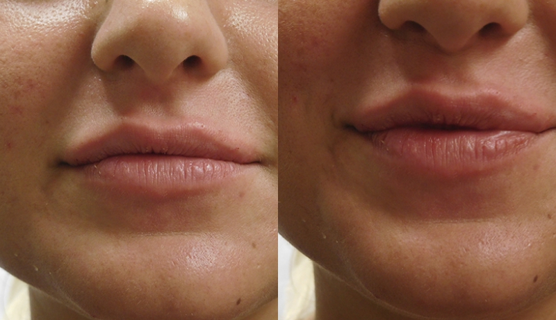 Injectables And Dermal Fillers Before & After Photos | Rottman Plastic Surgery