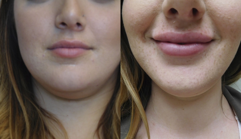 Injectables And Dermal Fillers Before & After Photos | Rottman Plastic Surgery