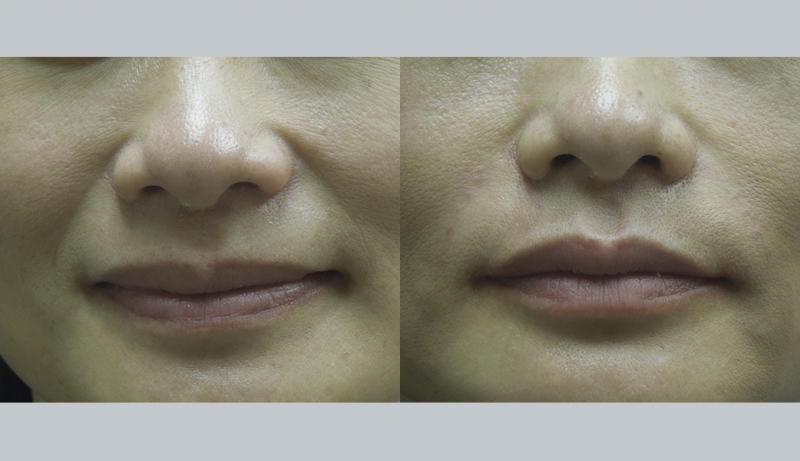 Injectables And Dermal Fillers Before & After Photos | Rottman Plastic Surgery