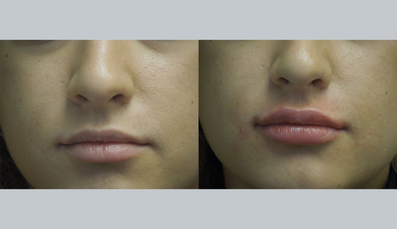 Injectables And Dermal Fillers Before & After Photos | Rottman Plastic Surgery