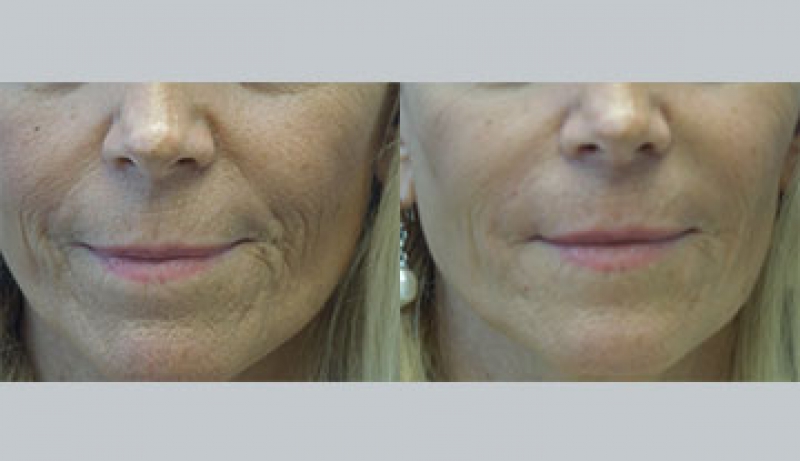 Injectables And Dermal Fillers Before & After Photos | Rottman Plastic Surgery