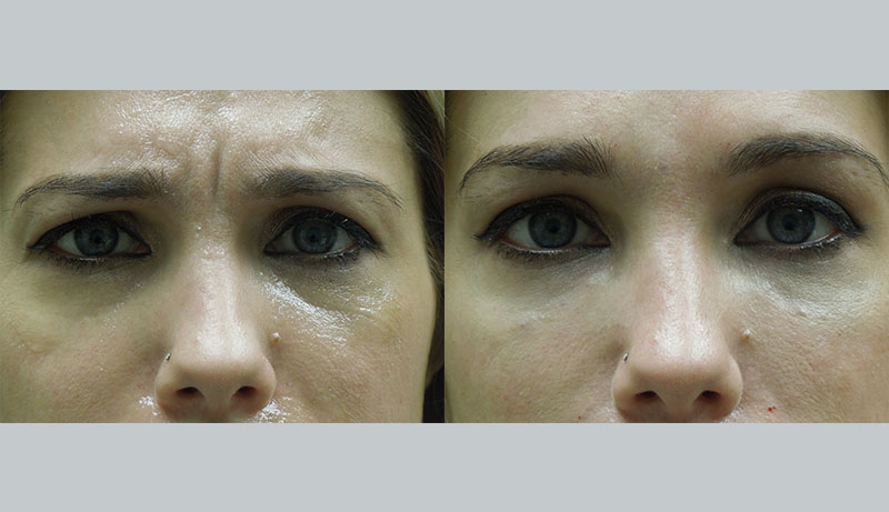 Injectables And Dermal Fillers Before & After Photos | Rottman Plastic Surgery