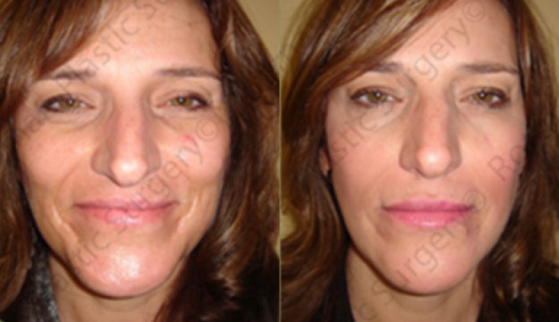 Injectables And Dermal Fillers Before & After Photos | Rottman Plastic Surgery