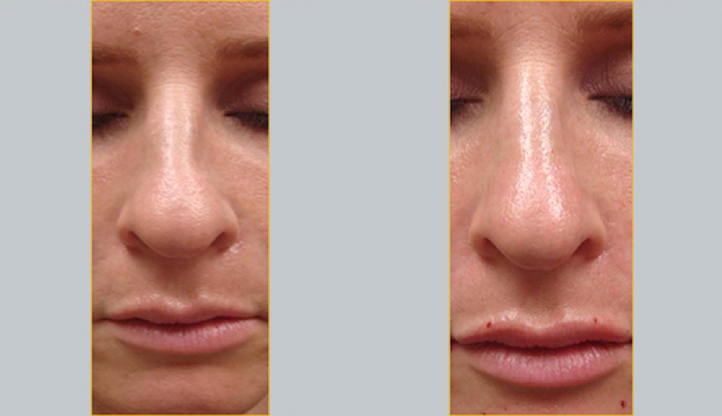Injectables And Dermal Fillers Before & After Photos | Rottman Plastic Surgery