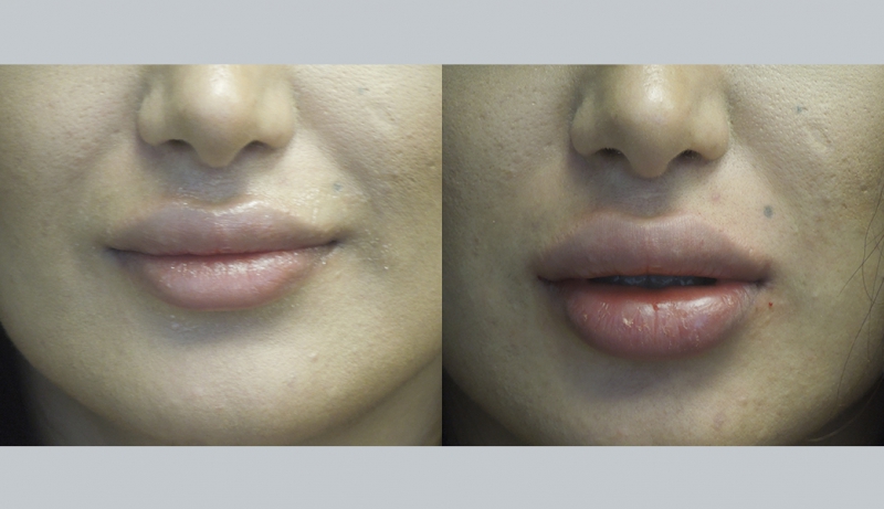 Injectables And Dermal Fillers Before & After Photos | Rottman Plastic Surgery