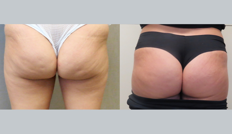 Injectables And Dermal Fillers Before & After Photos | Rottman Plastic Surgery