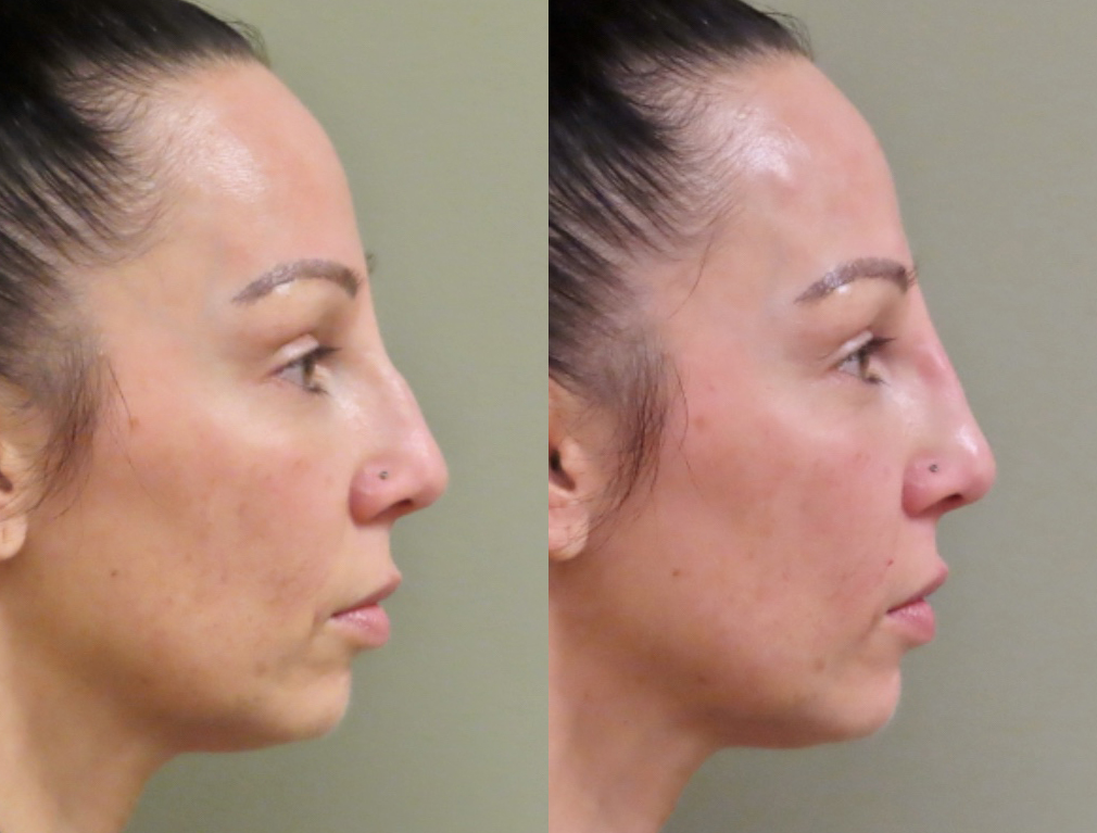 Injectables And Dermal Fillers Before & After Photos | Rottman Plastic Surgery