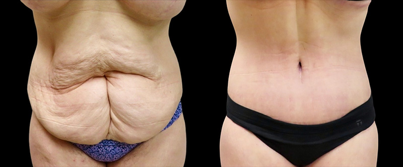 Liposuction Before & After Photos | Rottman Plastic Surgery