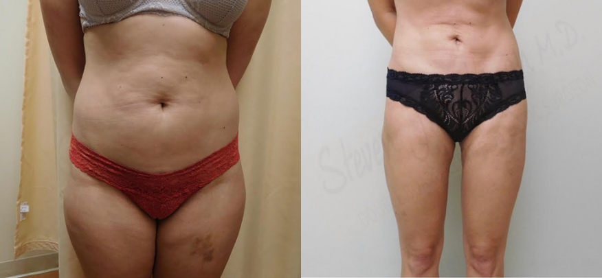 Liposuction Before & After Photos | Rottman Plastic Surgery