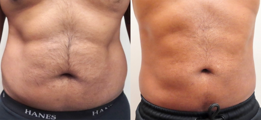 Liposuction Before & After Photos | Rottman Plastic Surgery