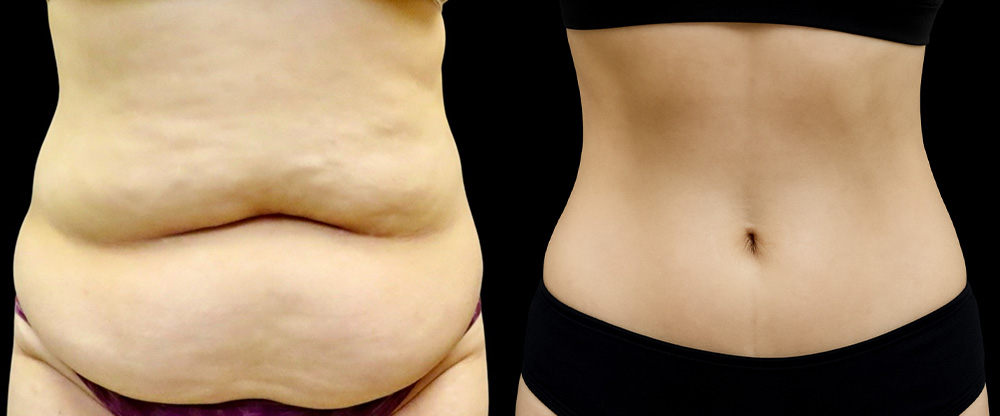 Mini Tuck And Tummy Tuck (abdominoplasty) Before & After Photos | Rottman Plastic Surgery