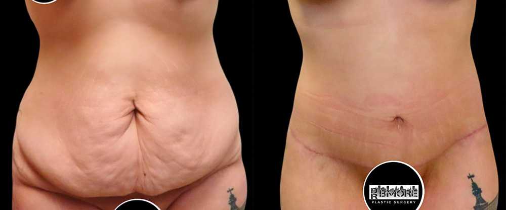 Mini Tuck And Tummy Tuck (abdominoplasty) Before & After Photos | Rottman Plastic Surgery