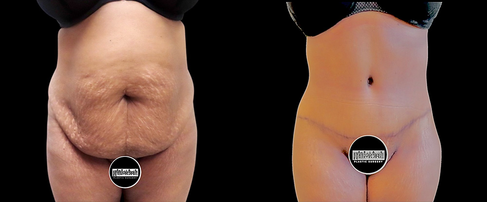 Mini Tuck And Tummy Tuck (abdominoplasty) Before & After Photos | Rottman Plastic Surgery
