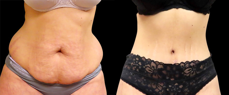 Mini Tuck And Tummy Tuck (abdominoplasty) Before & After Photos