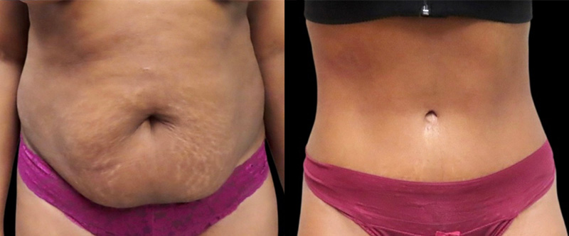 Mini Tuck And Tummy Tuck (abdominoplasty) Before & After Photos | Rottman Plastic Surgery