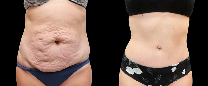 Mini Tuck And Tummy Tuck (abdominoplasty) Before & After Photos | Rottman Plastic Surgery