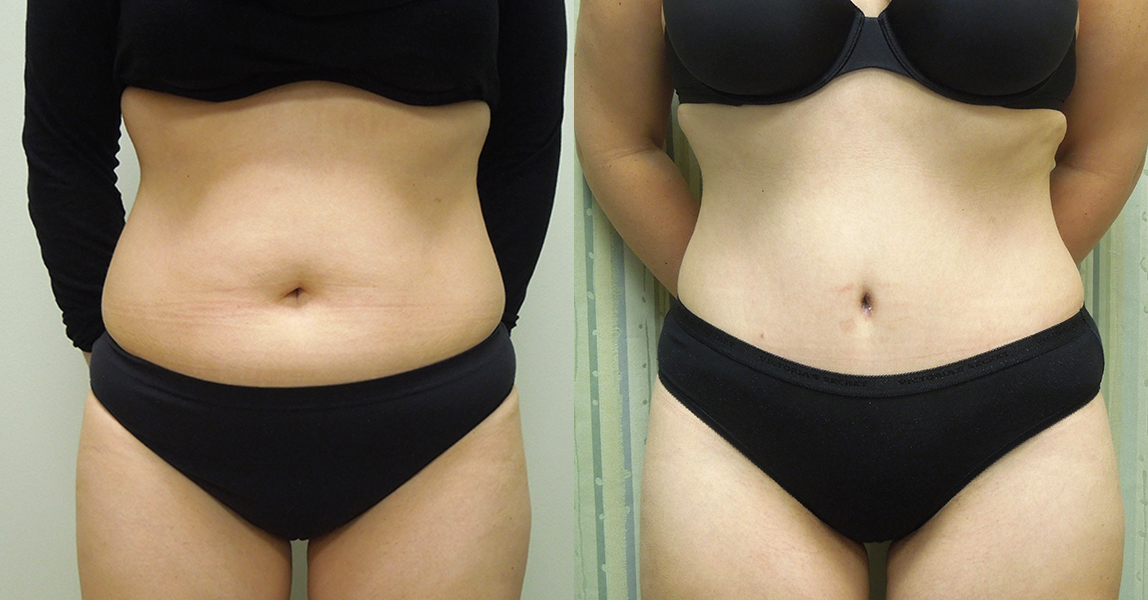 Tummy Tuck Revision Surgery Before and After