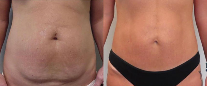 Mini Tuck And Tummy Tuck (abdominoplasty) Before & After Photos | Rottman Plastic Surgery