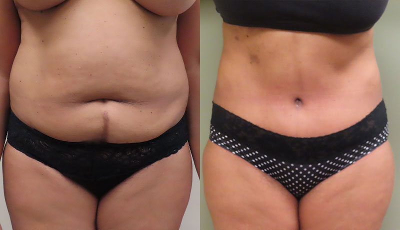 Mini Tuck And Tummy Tuck (abdominoplasty) Before & After Photos | Rottman Plastic Surgery