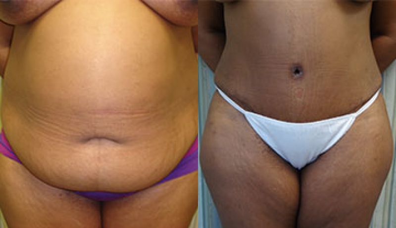 Mini Tuck And Tummy Tuck (abdominoplasty) Before & After Photos | Rottman Plastic Surgery
