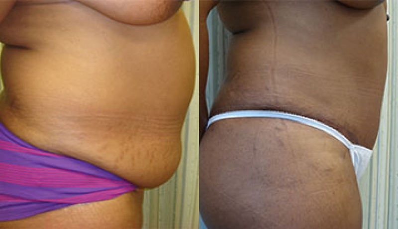 Mini Tuck And Tummy Tuck (abdominoplasty) Before & After Photos | Rottman Plastic Surgery