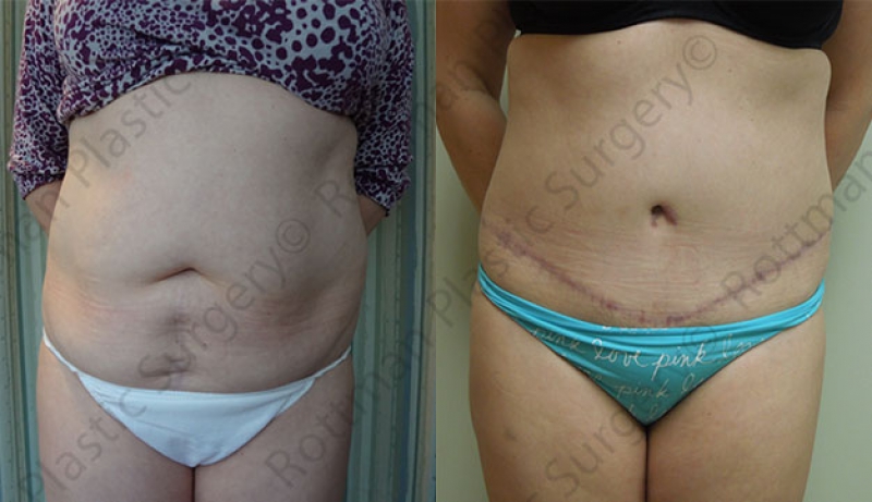 Mini Tuck And Tummy Tuck (abdominoplasty) Before & After Photos | Rottman Plastic Surgery