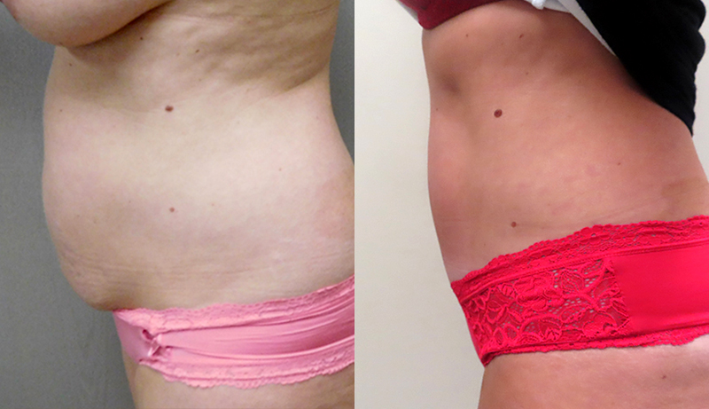 Mini Tuck And Tummy Tuck (abdominoplasty) Before & After Photos | Rottman Plastic Surgery