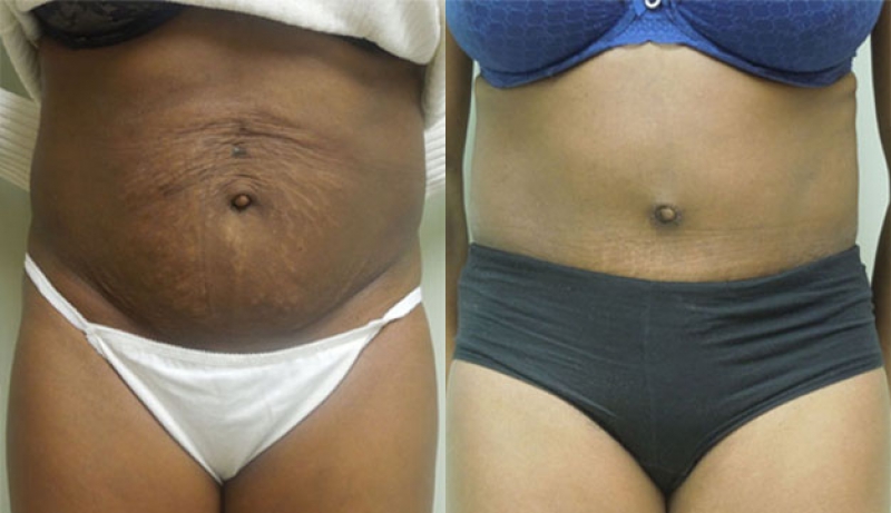 Mini Tuck And Tummy Tuck (abdominoplasty) Before & After Photos | Rottman Plastic Surgery
