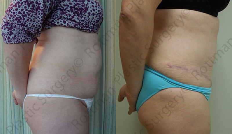 Mini Tuck And Tummy Tuck (abdominoplasty) Before & After Photos | Rottman Plastic Surgery