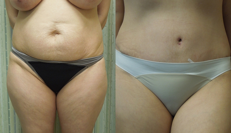 Mini Tuck And Tummy Tuck (abdominoplasty) Before & After Photos | Rottman Plastic Surgery