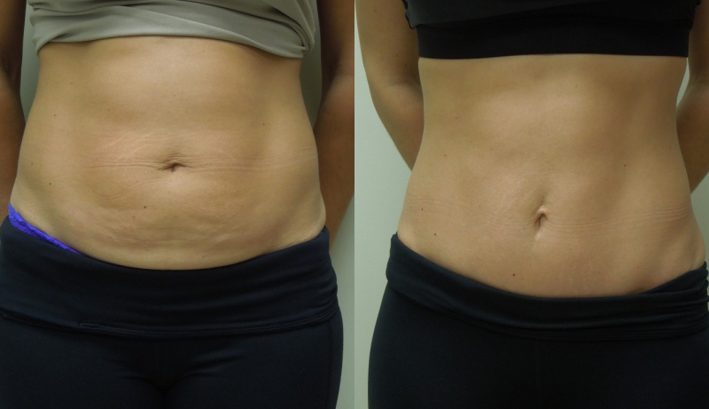 Mini Tuck And Tummy Tuck (abdominoplasty) Before & After Photos | Rottman Plastic Surgery