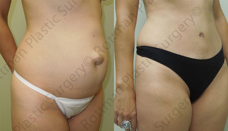 Mini Tuck And Tummy Tuck (abdominoplasty) Before & After Photos | Rottman Plastic Surgery