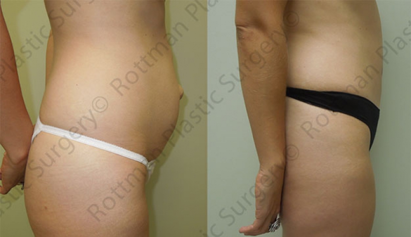 Mini Tuck And Tummy Tuck (abdominoplasty) Before & After Photos | Rottman Plastic Surgery
