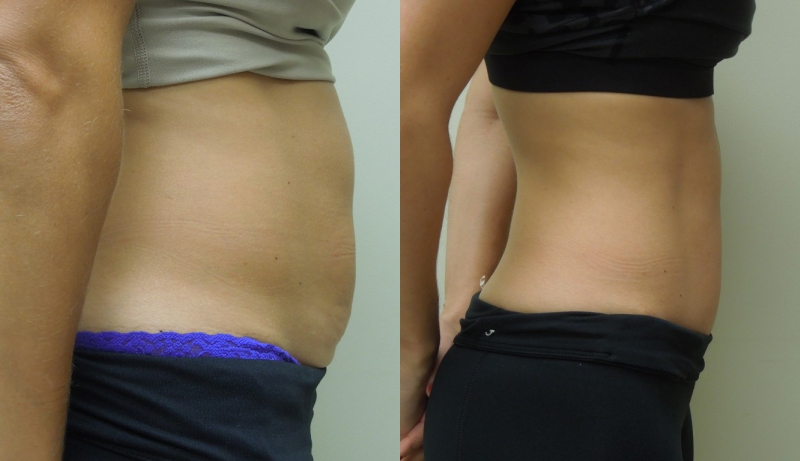 Mini Tuck And Tummy Tuck (abdominoplasty) Before & After Photos | Rottman Plastic Surgery