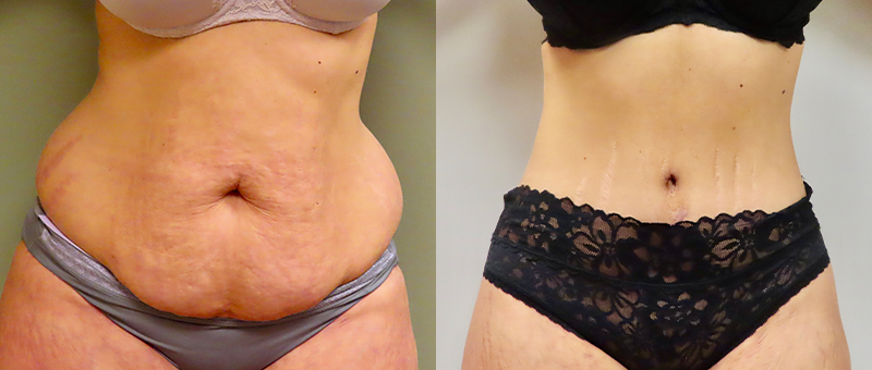 Mini Tuck And Tummy Tuck (abdominoplasty) Before & After Photos | Rottman Plastic Surgery