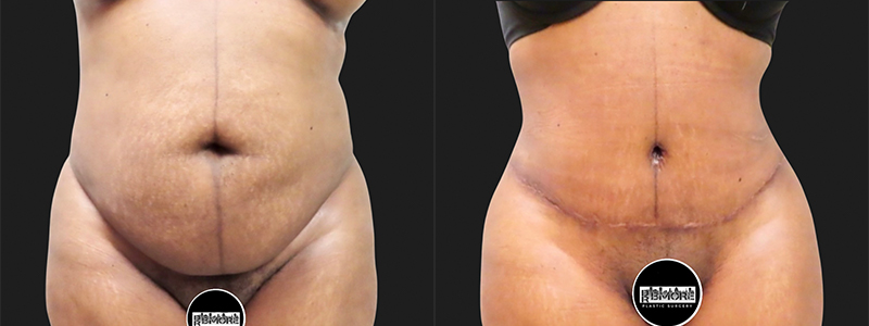 Mini Tuck And Tummy Tuck (abdominoplasty) Before & After Photos | Rottman Plastic Surgery