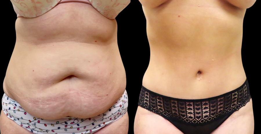 Mini Tuck And Tummy Tuck (abdominoplasty) Before & After Photos | Rottman Plastic Surgery